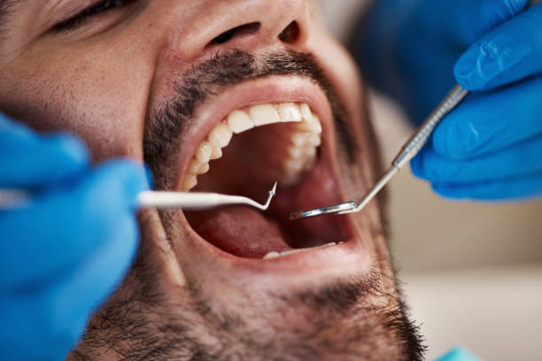 Best Emergency Dentist for Lost Fillings or Crowns in Rose Hills, CA